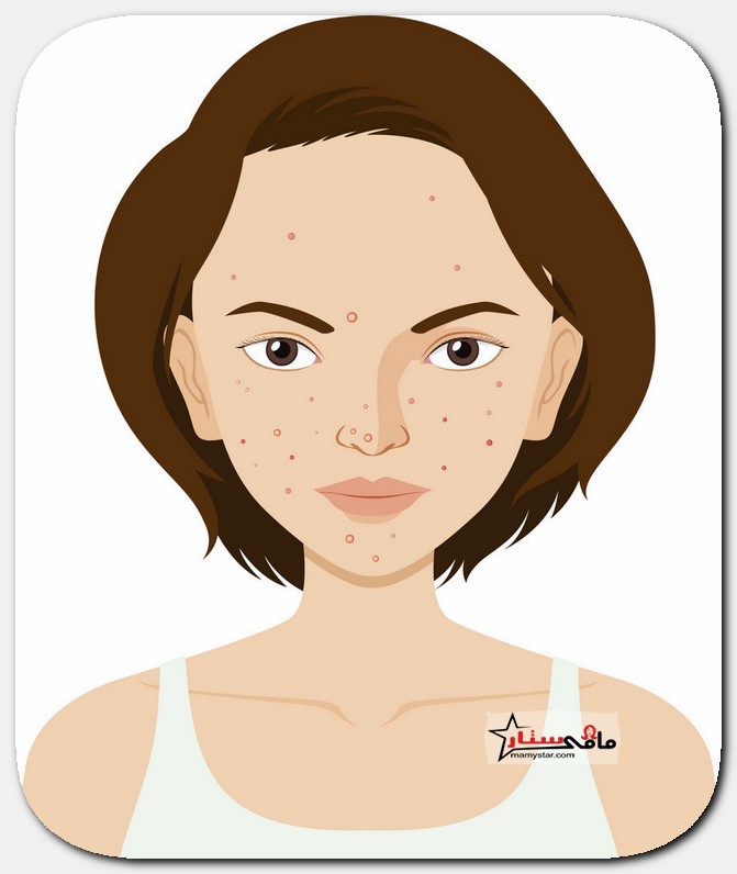 comedonal acne treatment