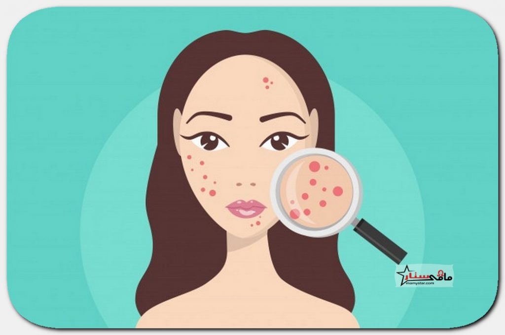 acne prevention
