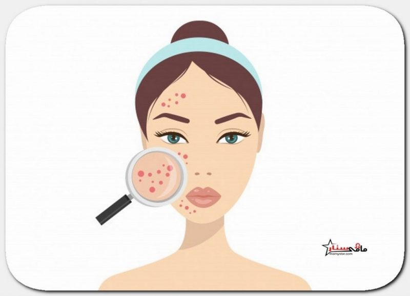 cystic acne treatment at home